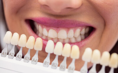 primer plano de boca mujer con gama de tonalidades dentales ¿Cuál es el mejor blanqueamiento dental?